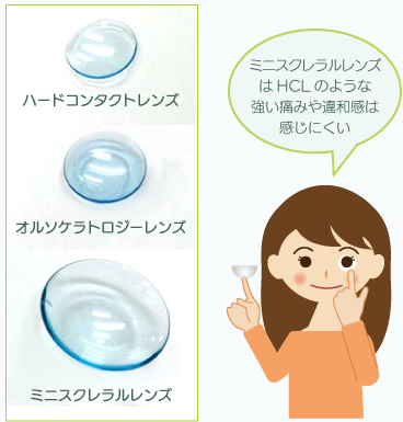 ハードコンタクトレンズとオルソケラトロジーレンズとミニスクレラルレンズの大きさを比較した画像