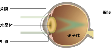 白内障の眼のイラスト