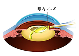 眼内レンズを挿入しているイラスト