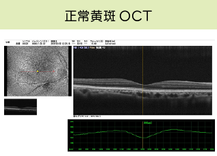 正常黄斑OCT画像