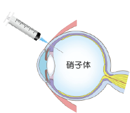 抗VEGF薬硝子体内注射のイメージイラスト