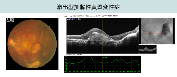 滲出型加齢性黄斑変性症の画像