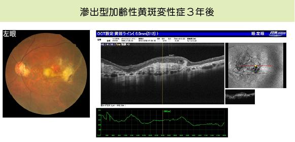 滲出型加齢性黄斑変性症3年後の画像