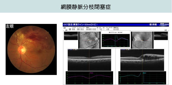 網膜静脈分枝閉塞症の画像