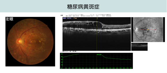 糖尿病黄斑症の画像