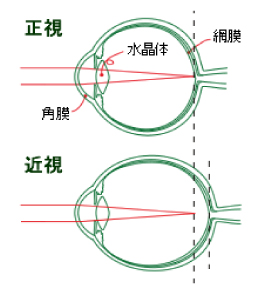 近視の原因イメージ図