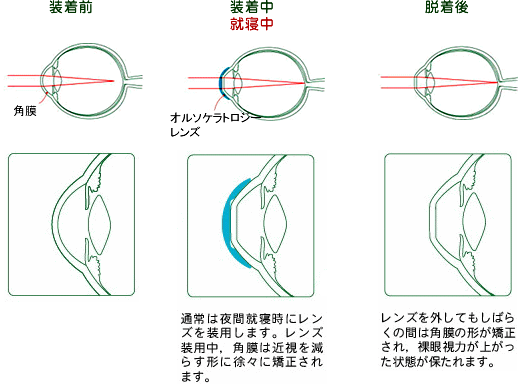 オルソケラトロジーレンズ装着前、装着中、脱着後のイメージイラスト