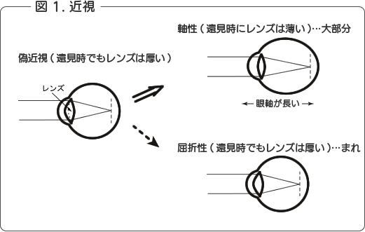 近視になる仕組みを説明した図