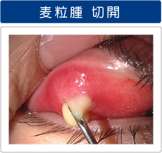 麦粒腫を切開している写真