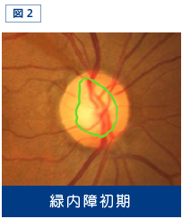 図2：緑内障初期