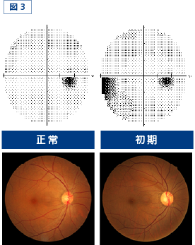 図3：正常・初期