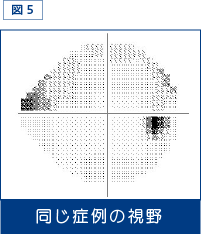 図5：同じ症例の視野