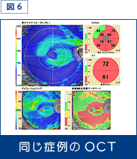 図6：同じ症例のOCT