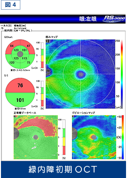 図4緑内障初期OCT画像