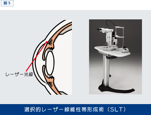 図5.選択的レーザー線維柱帯形成術（SLT）