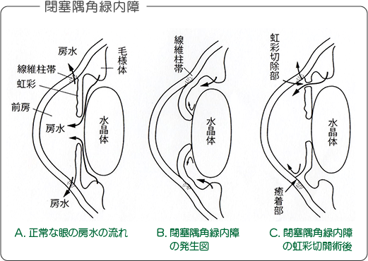 閉塞隅角緑内障の図