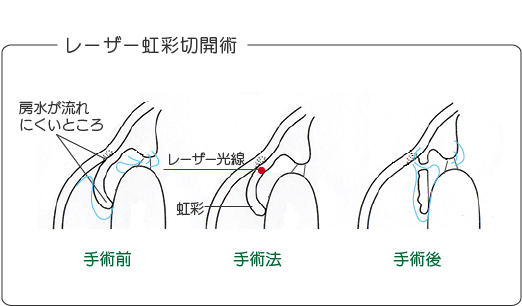 レーザー虹彩切開術のイメージイラスト