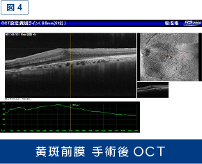 黄斑前膜手術後OCT画像