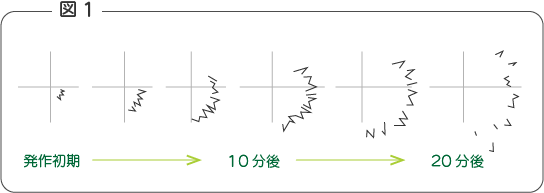 閃輝暗点の典型的な症状の図